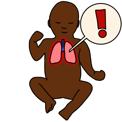 an infant with dark brown skin and pink lungs outlined in red. a white circle with a red exclamation mark in it connects to the lungs.